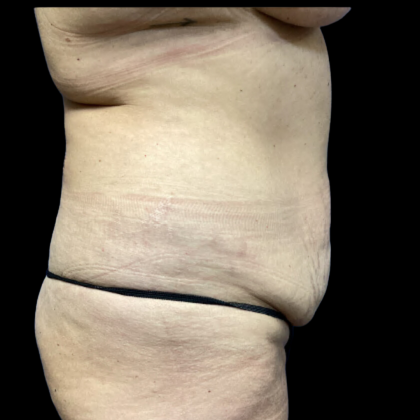 Tummy Tuck Before & After Patient #4576