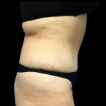 Tummy Tuck Before & After Patient #4576