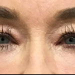 Blepharoplasty Before & After Patient #4633