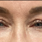 Blepharoplasty Before & After Patient #4633