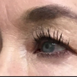 Blepharoplasty Before & After Patient #4633