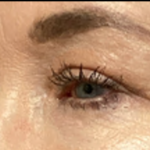 Blepharoplasty Before & After Patient #4633