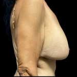 Breast Augmentation Before & After Patient #4580