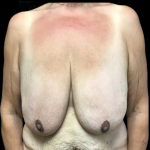 Breast Augmentation Before & After Patient #4580