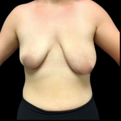 Breast Augmentation Before & After Patient #4684
