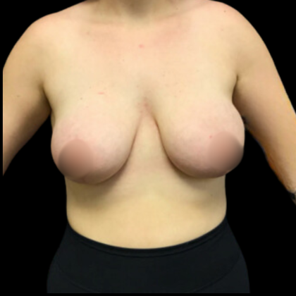 Breast Augmentation Before & After Patient #4684