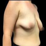 Breast Augmentation Before & After Patient #4684