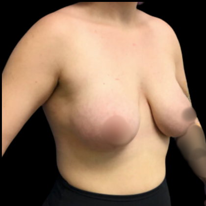 Breast Augmentation Before & After Patient #4684