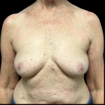 Breast Augmentation Before & After Patient #4685