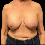 Breast Augmentation Before & After Patient #4685