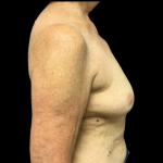Breast Augmentation Before & After Patient #4685