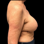 Breast Augmentation Before & After Patient #4685