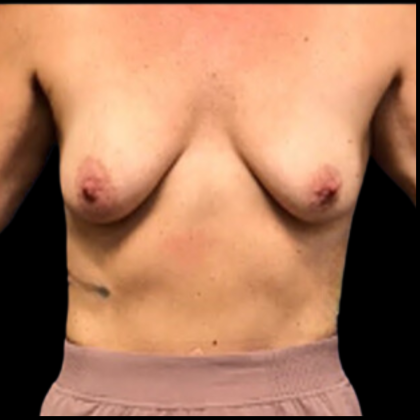 Breast Augmentation Before & After Patient #4686