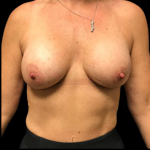 Breast Augmentation Before & After Patient #4686
