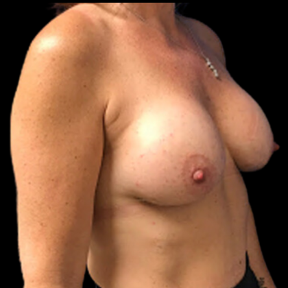 Breast Augmentation Before & After Patient #4686