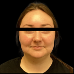 Neck Lift Before & After Patient #4687