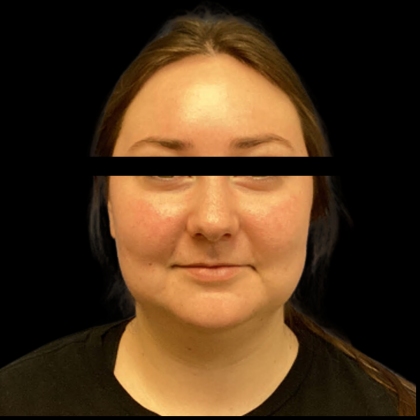 Neck Lift Before & After Patient #4687