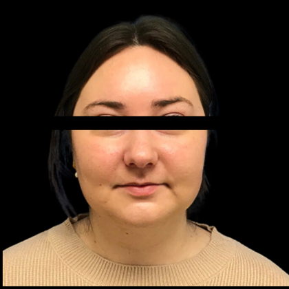 Neck Lift Before & After Patient #4687