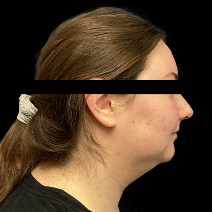 Neck Lift Before & After Patient #4687