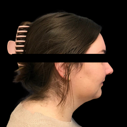 Neck Lift Before & After Patient #4687
