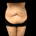 Tummy Tuck Before & After Patient #4688