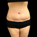 Tummy Tuck Before & After Patient #4688