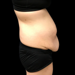 Tummy Tuck Before & After Patient #4688