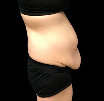 Tummy Tuck Before & After Patient #4688