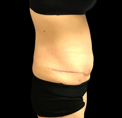 Tummy Tuck Before & After Patient #4688