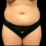 Tummy Tuck Before & After Patient #4689