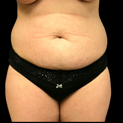Tummy Tuck Before & After Patient #4689