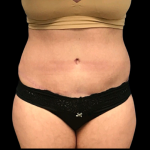 Tummy Tuck Before & After Patient #4689