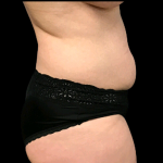 Tummy Tuck Before & After Patient #4689