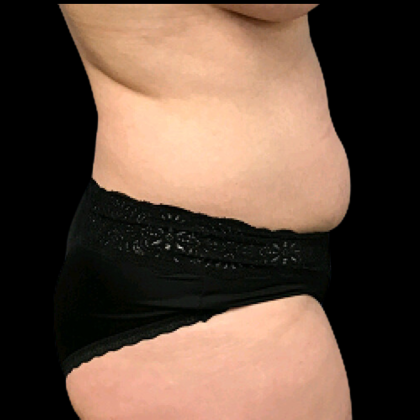 Tummy Tuck Before & After Patient #4689