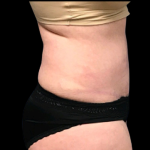 Tummy Tuck Before & After Patient #4689
