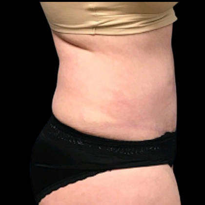 Tummy Tuck Before & After Patient #4689