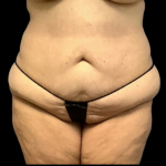Tummy Tuck Before & After Patient #4318