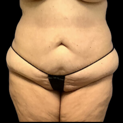 Tummy Tuck Before & After Patient #4318