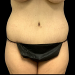 Tummy Tuck Before & After Patient #4318