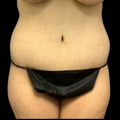 Tummy Tuck Before & After Patient #4318