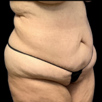 Tummy Tuck Before & After Patient #4318
