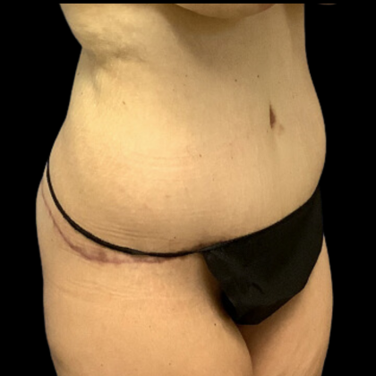 Tummy Tuck Before & After Patient #4318