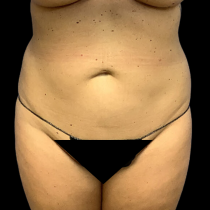 Tummy Tuck Before & After Patient #4322