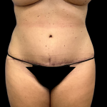 Tummy Tuck Before & After Patient #4322