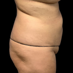 Tummy Tuck Before & After Patient #4322