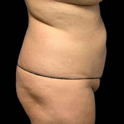 Tummy Tuck Before & After Patient #4322