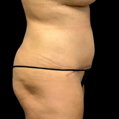 Tummy Tuck Before & After Patient #4322