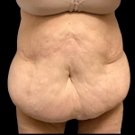 Tummy Tuck Before & After Patient #4320