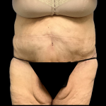 Tummy Tuck Before & After Patient #4320