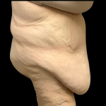Tummy Tuck Before & After Patient #4320